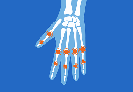 A graphic representation of a skeletal hand with hotspots on the joints