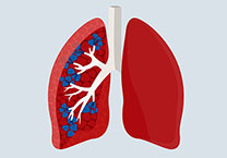 a graphic of lungs with one side as a cross section displaying blue nodules